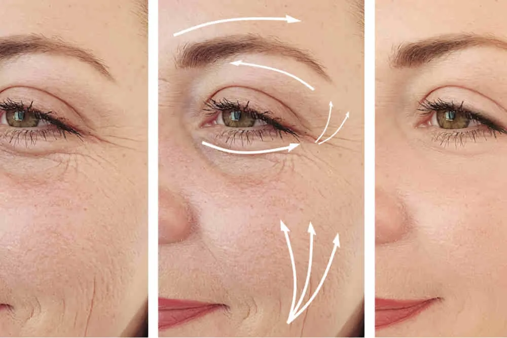 What-is-Canthoplasty