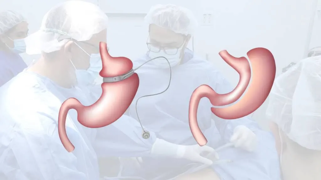 Bariatric-Revision-Surgery gastric bypass revision surgery