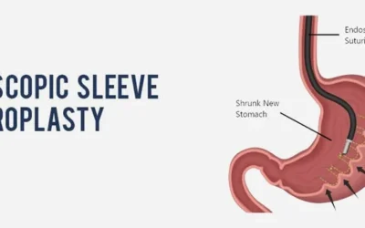 How Endoscopic Sleeve Gastroplasty Fits Into Modern Weight Loss Treatment