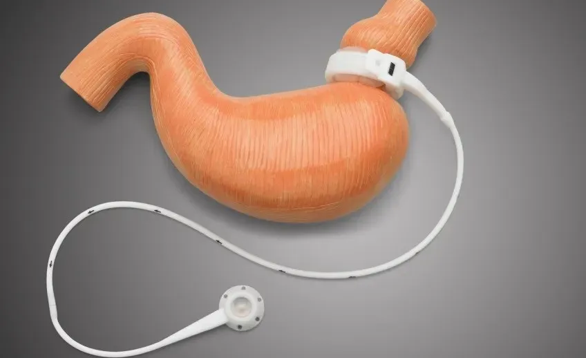 lap-band lap band surgery