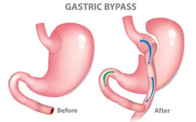 Is Gastric Bypass Reversible? Everything You Need to Know Before Surgery