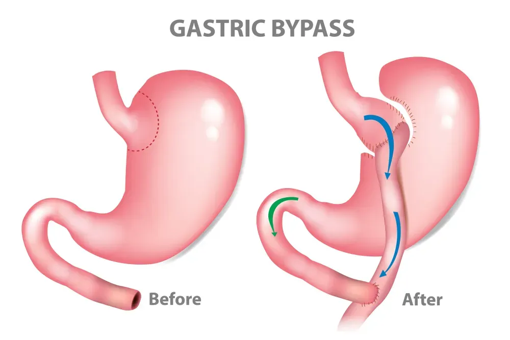 Is Gastric Bypass Reversible