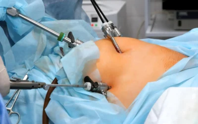 Start Your Weight Loss Journey with Robotic Gastric Bypass Surgery