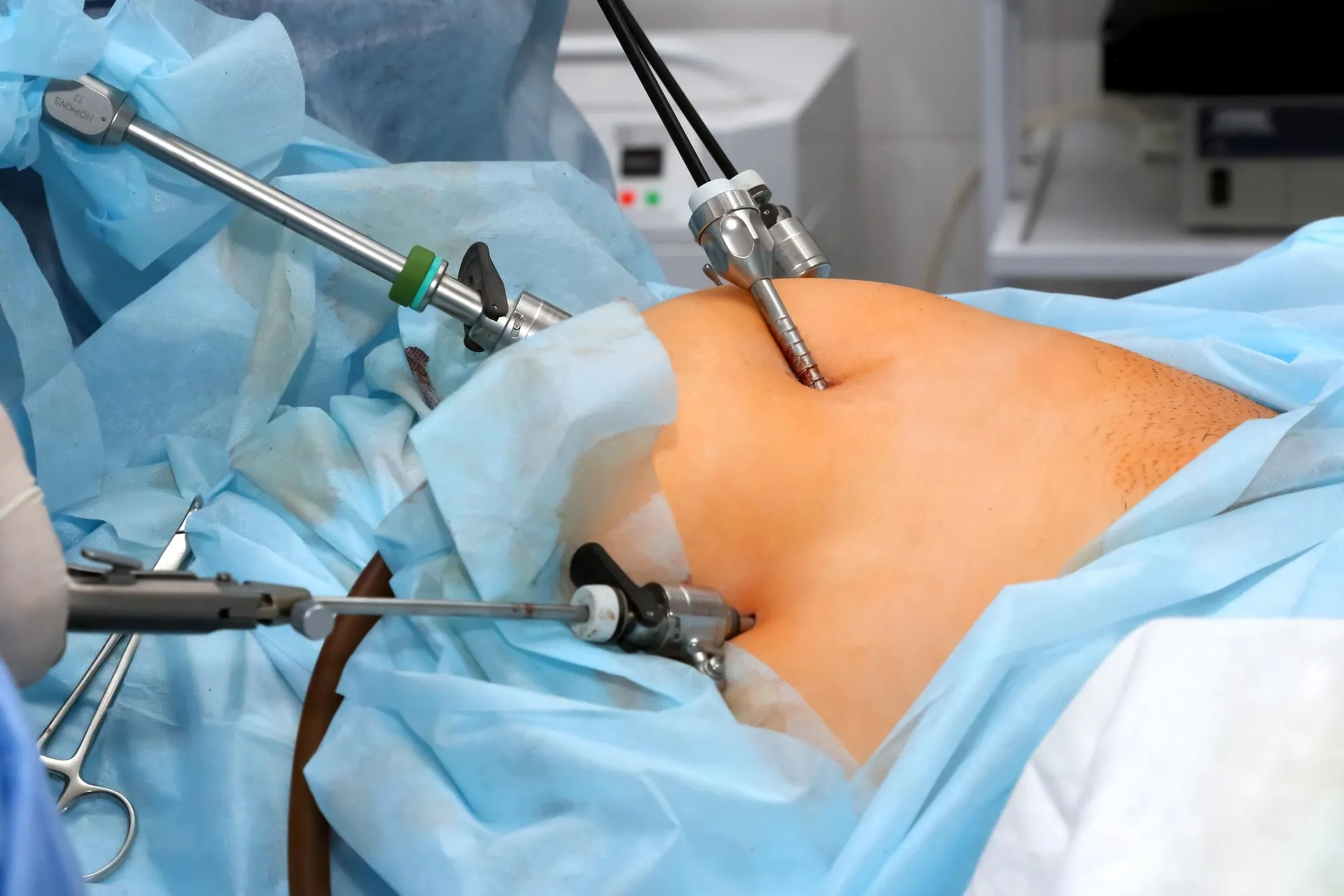 Robotic Gastric Bypass Surgery