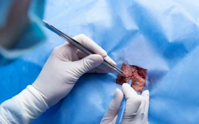 Top Pilonidal Cyst Specialists for Recurring Cyst Treatment