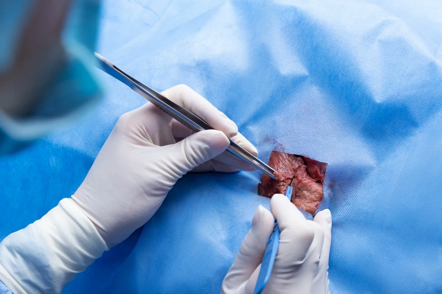 Pilonidal Cyst Specialists
