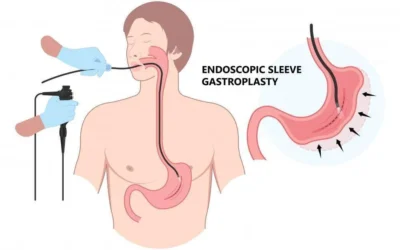 Everything You Need to Know About Endoscopic Sleeve Gastroplasty