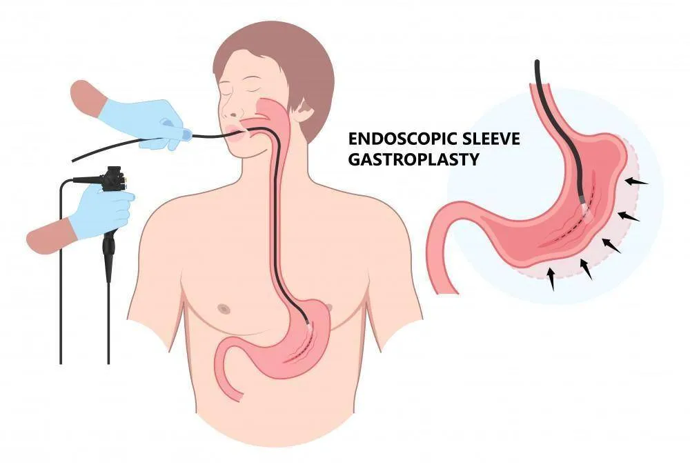Endoscopic Sleeve Gastroplasty
